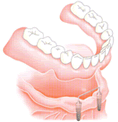 インプラント治療（総入れ歯）